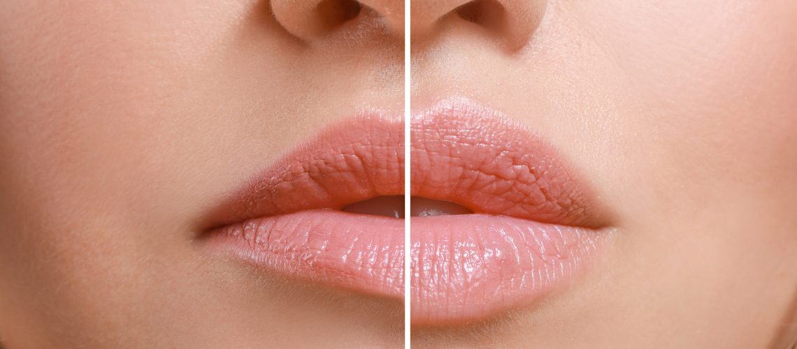 lip filler before and after